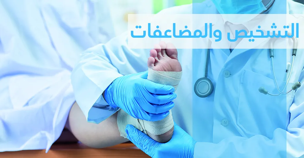 ماهو مرض الدّوالي وماهي أعراضه ؟